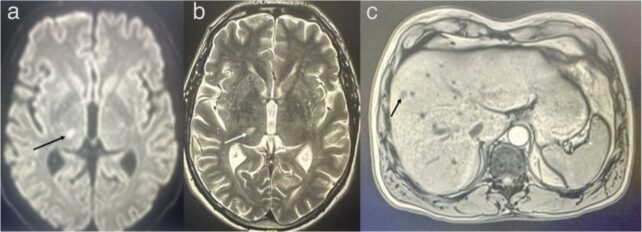 Energy Drinks Stroke