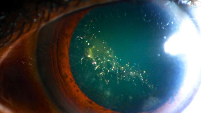 a closeup of a human eye with dilated pupil showing a galaxy-like strip of sparkles within the pupil