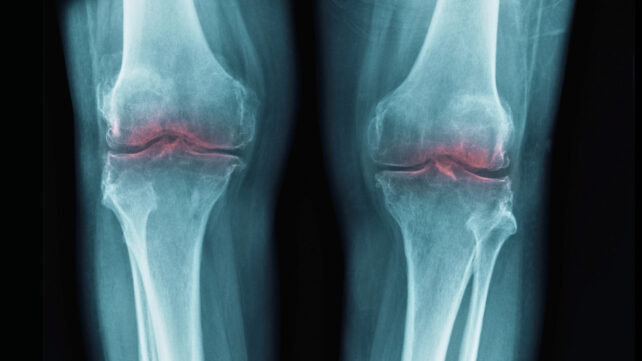 Knees showing inflammation on X-ray