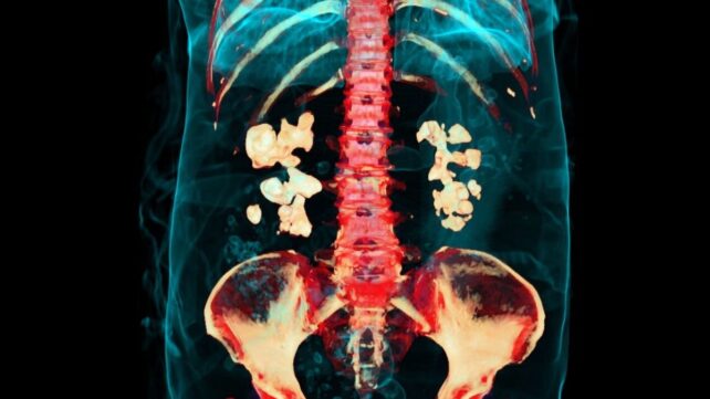 Bacteria Play Previously Unknown Role in Kidney Stones, Study Finds