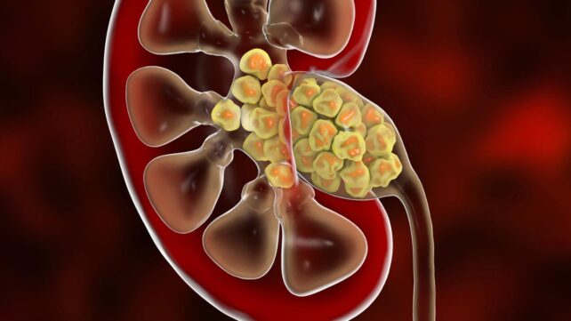 Surprising Find Inside Kidney Stones Suggests We Were Wrong About How They Form