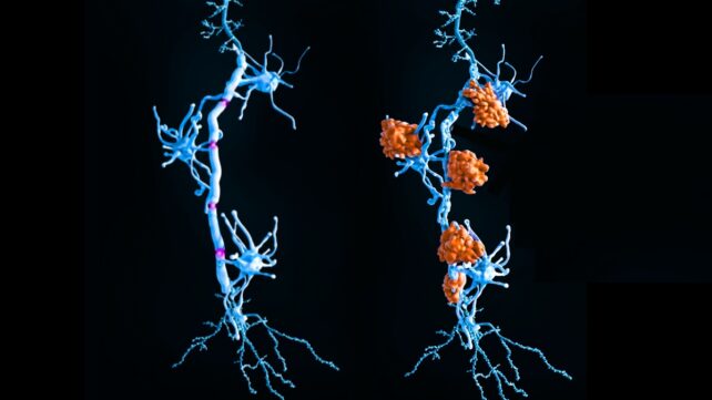 Two neurons, one showing damage to it's myelin sheath, from MS