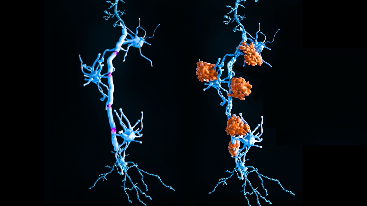Multiple Sclerosis May Have Two Distinct Subtypes, Scientists Discover