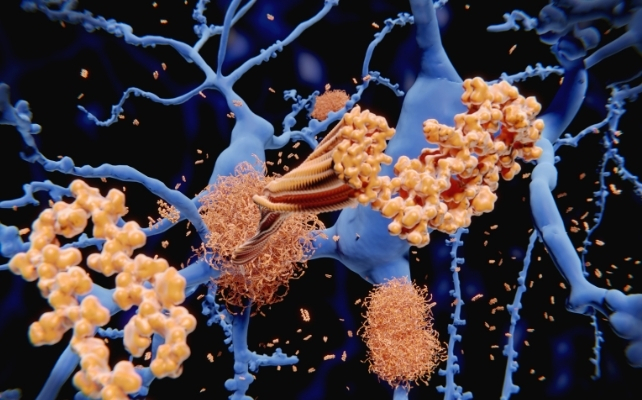 illustration of amyloid beta plaques