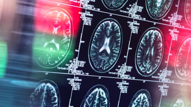 Alzheimer's Might Not Actually Be a Brain Disease, Reveals Expert