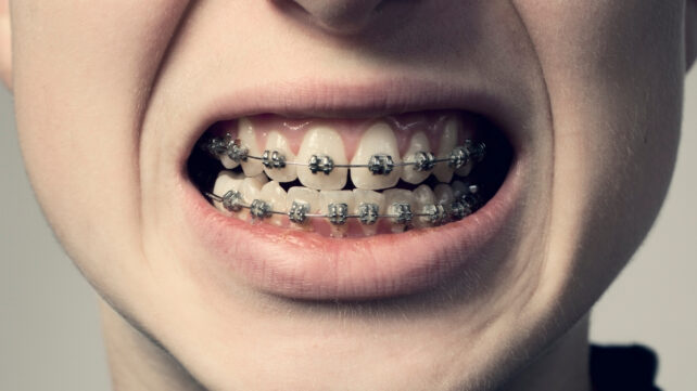 adolescent with braces