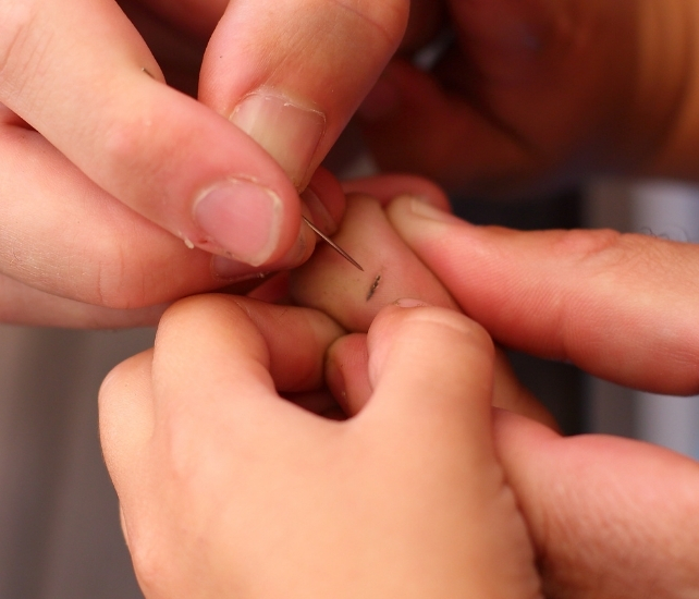 splinter being removed
