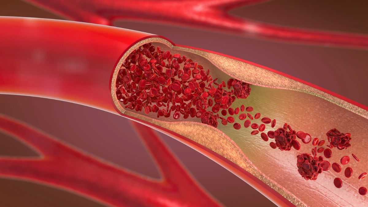 'Remnant' Cholesterol Cut by More Than 60 Percent in New Drug Trial