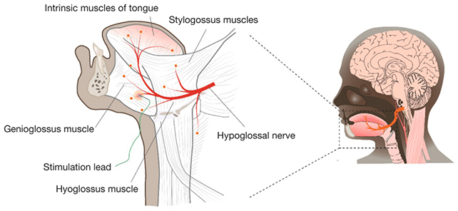 Hypoglossal nerve stimulation