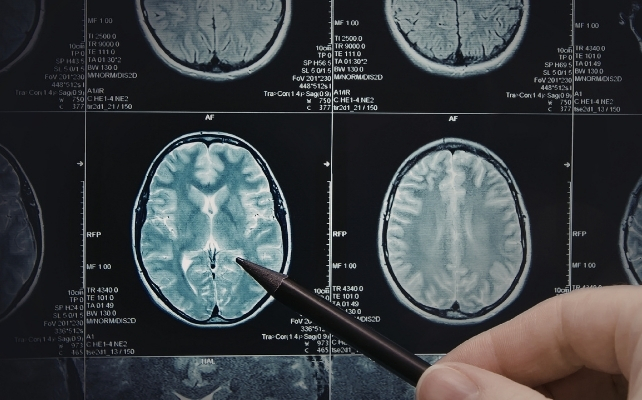 mri scans of a brain