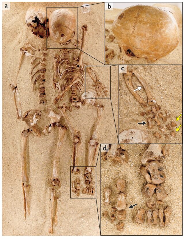 two skeletons, one much shorter than the other, are partially submerged in sand. The taller skeleton has its arm around the shoulders of the other.