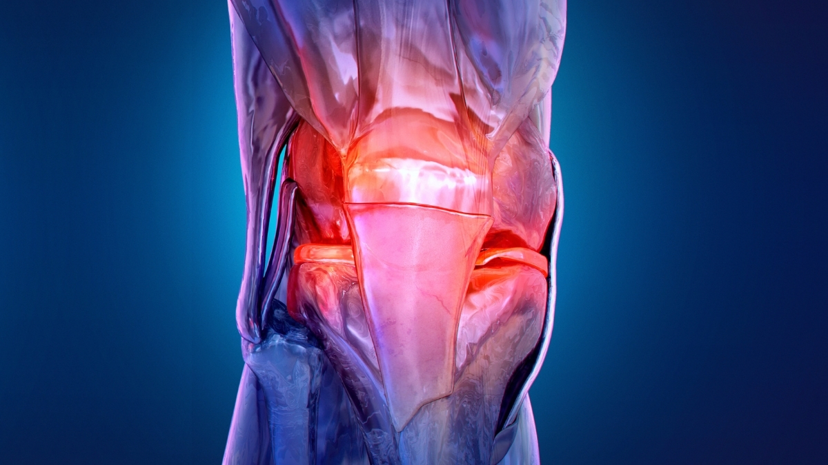 Osteoarthritis Is Appearing in Younger Adults, Triggering Decades of Discomfort