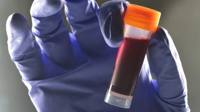 One Blood Type Appears to Carry a Higher Risk of Type 2 Diabetes