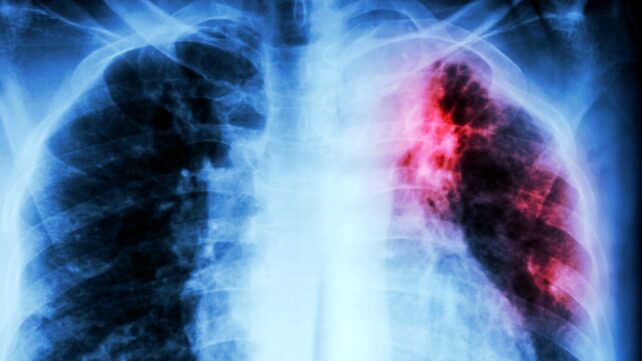 x-ray with red highlight