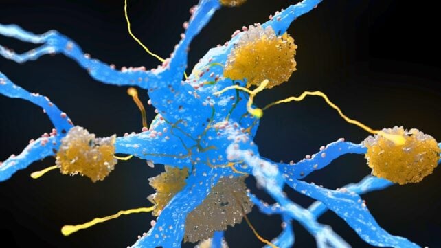 Illustration of amyloid plaques building up around blue neurons, representing the protein deposits associated with Alzheimer's disease