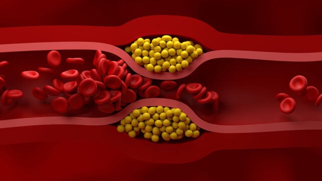 Partly blocked vessel in high level of LDL (bad cholesterol) lipoprotein
