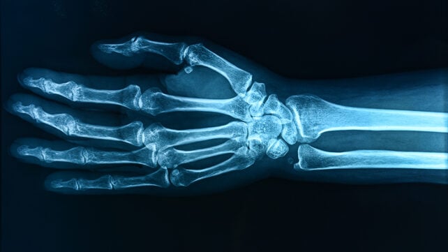 X-ray hand