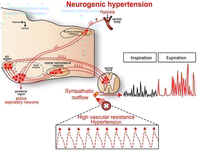 Hypertension diagram