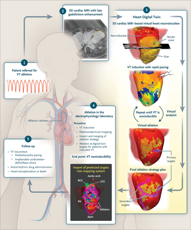 Digital Twin of a Patient's Heart Helped Doctors Treat a Deadly Rhythm