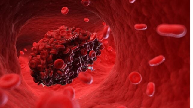 Illustration of blood cells clotting in the bloodstream