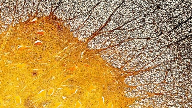 World MS Day: Immune Cell Discovery Might Explain Multiple Sclerosis at Its Worst