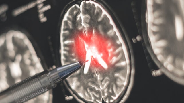 Inflamed brain