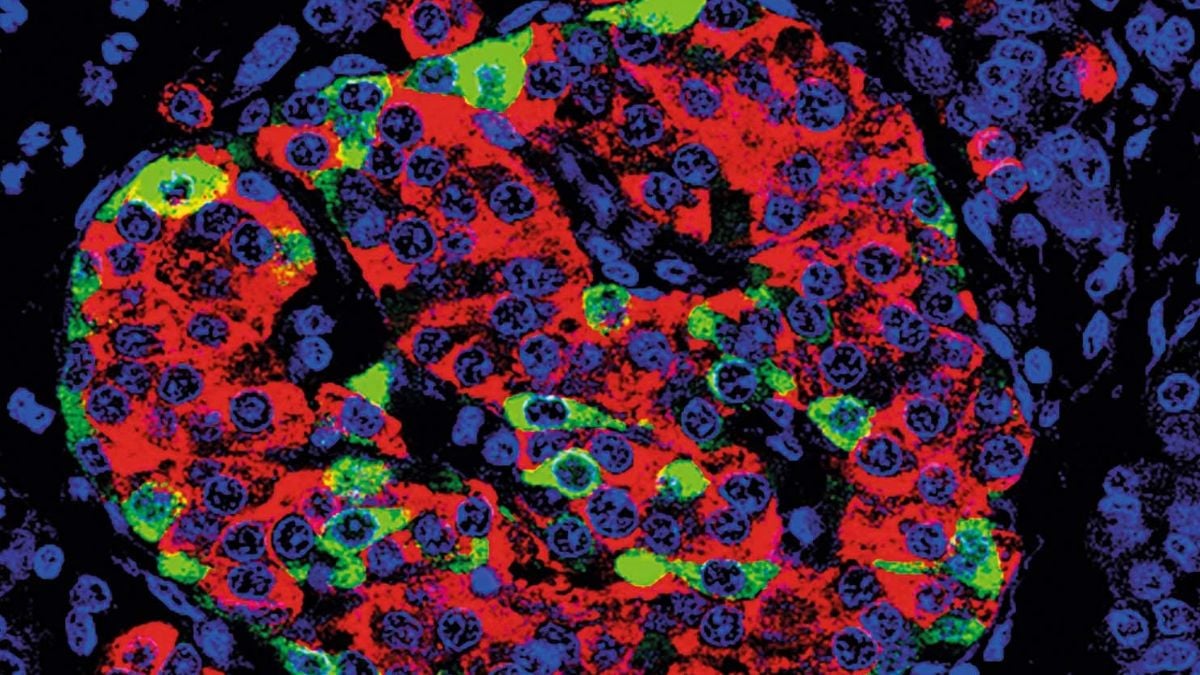 Stem Cells Can Revive Insulin Production in Type 1 Diabetes, Trials Show