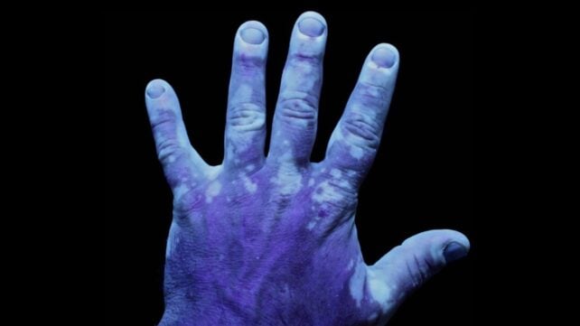 The Stigma Around This Common Skin Condition Runs Deeper Than You Think