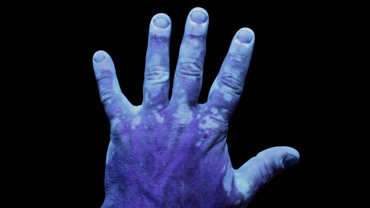 The Stigma Around This Common Skin Condition Runs Deeper Than You Think