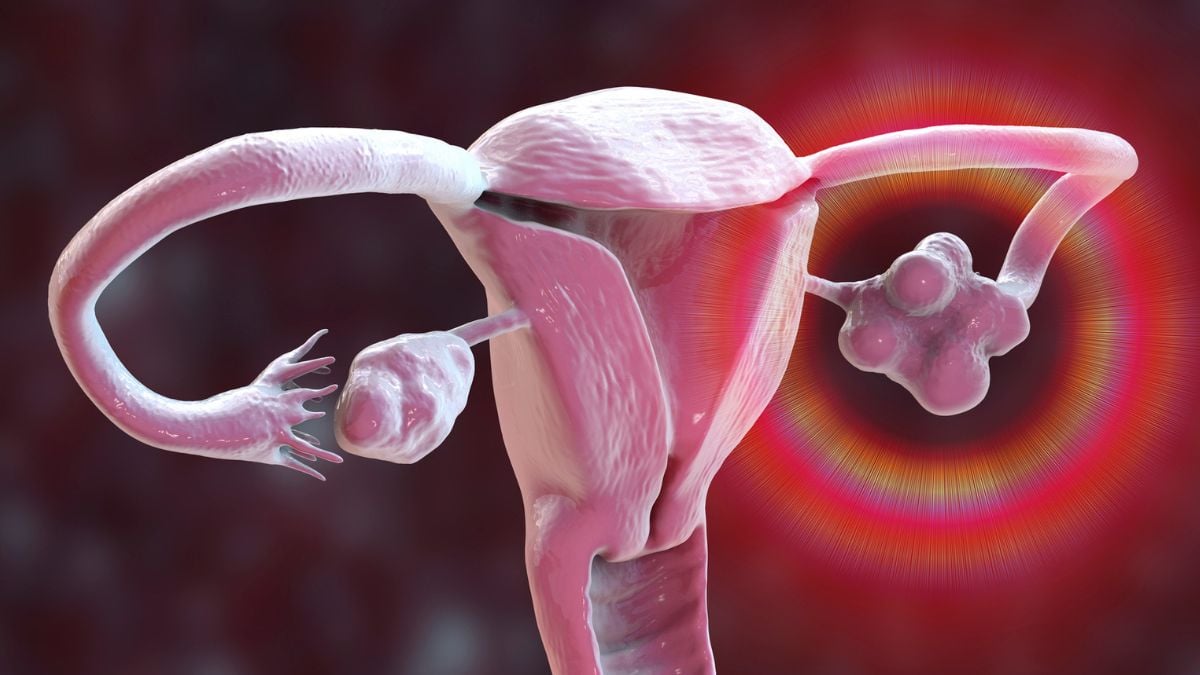 PCOS Is Officially Renamed, After Decades of Misinformation