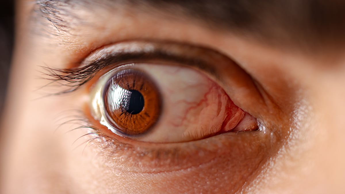 Spinach-Based Eye Drops Could Help Treat a Common Eye Condition