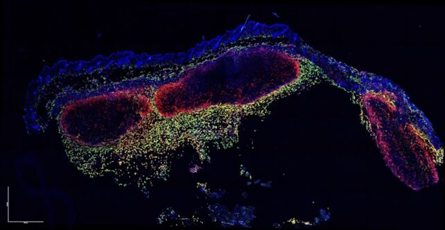 Watch: Immune Cells Caught on Video Eating Live Skin Cancer Cells