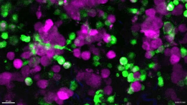 Watch: Immune Cells Caught on Video Eating Live Skin Cancer Cells