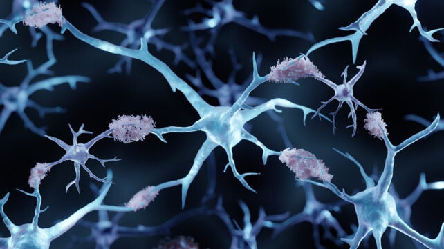3D illustration showing amyloid plaques in Alzheimer's disease