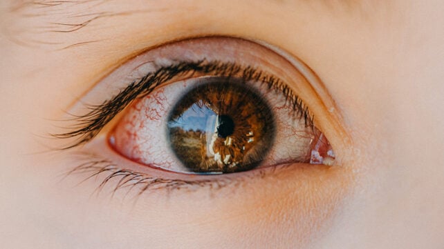 Child's red eye