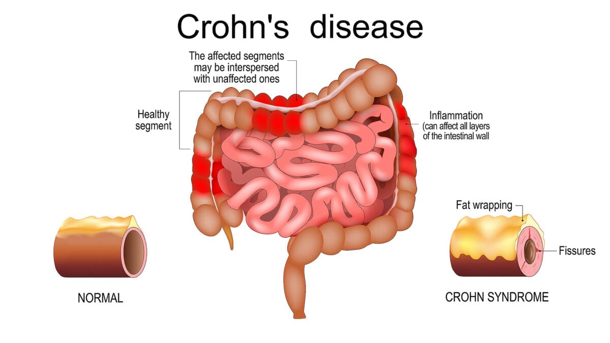Crohn disease. Human large and small intestine with healthy segments and inflammation that affect layers of the intestinal wall. The affected segments are interspersed with unaffected ones. Close-up of a cross section of an intestinal wall with fat wrapping and fissures