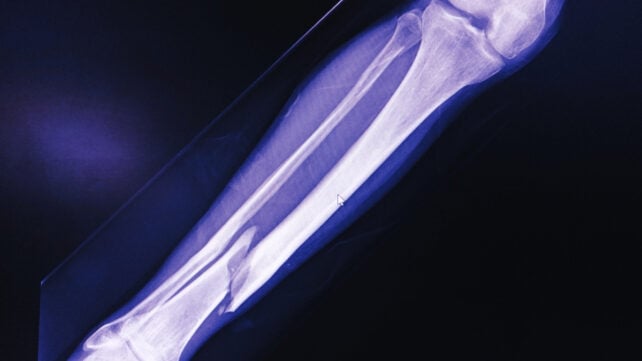 E-Bikes Are Linked to a Disturbing New Injury Phenomenon, Experts Warn
