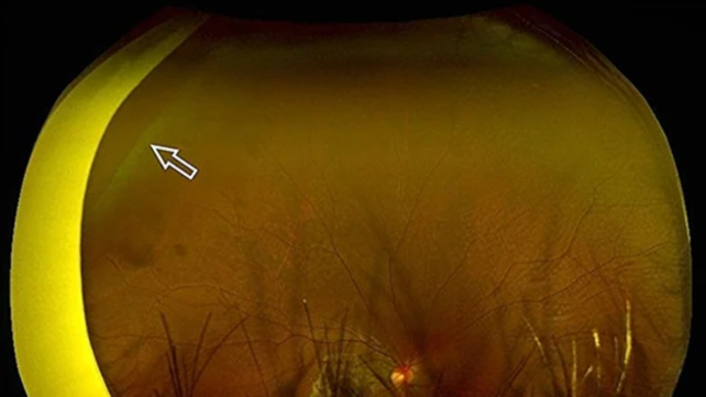 Disturbing Case Study Shows Why You Should Never Use a Massage Gun Near Your Eyes