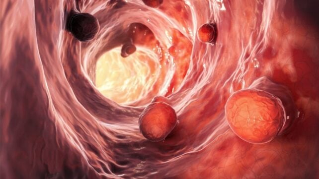 Gut Microbiome Could Remain Disrupted For Over a Decade After Polyp Removal