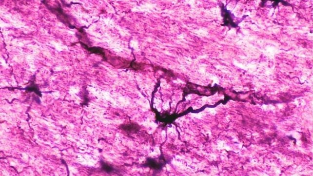 Two People With Severe Autoimmune Disease in Remission After Immune 'Reset'