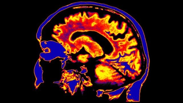 Scientists Discover a Potential Driver of Chronic Fatigue Syndrome Hiding Deep in The Brain