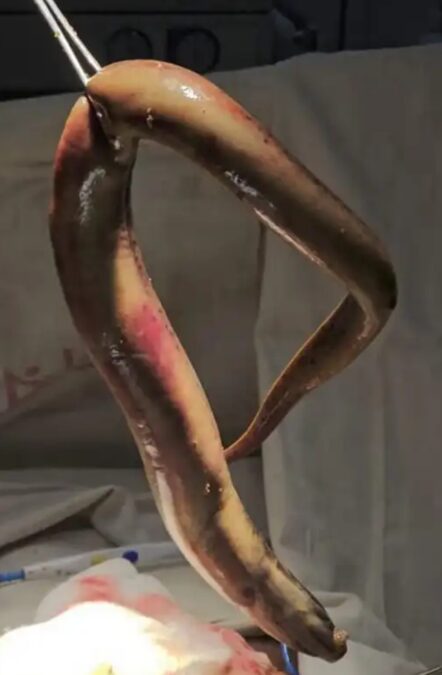 A Patient With a Perforated Bowel Shows Why Eels Shouldn't Be Anywhere Near Your Butt