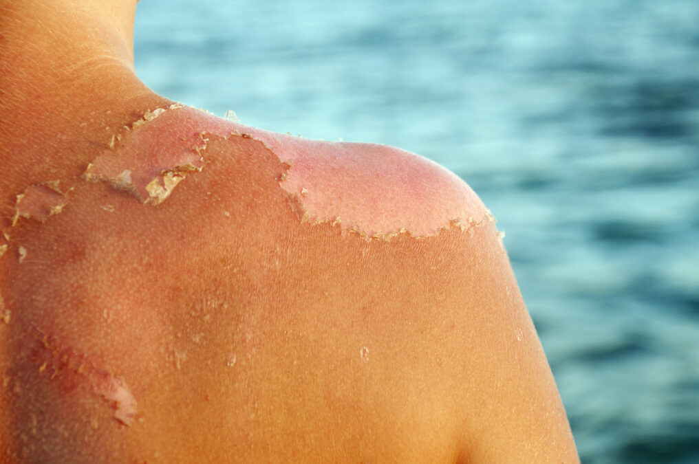 Dermatologists Are Shaking Their Heads at This Injectable Tan Trend