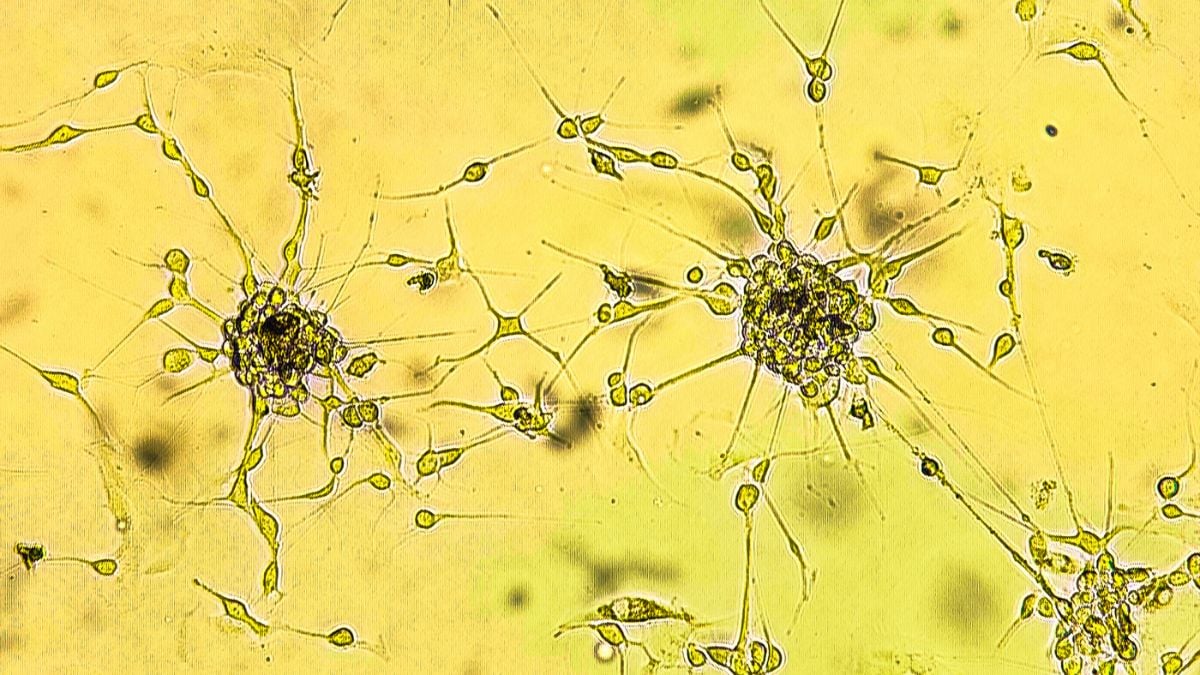 Nanoparticles Cross Blood-Brain Barrier in Mice to Shrink Deadly Glioblastoma