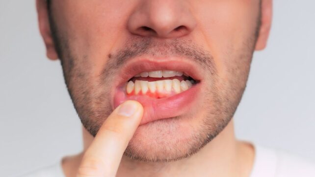 Gum Disease Improved With Just 6 Weeks of Taking Bacteria-Loaded Gummies
