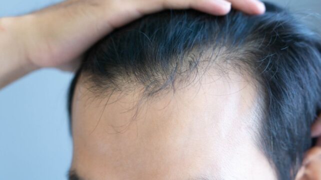 Uh Oh, GLP-1 Drugs Have Been Linked to a Higher Risk of Hair Loss
