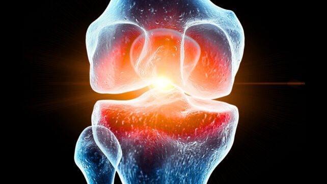 Illustration of a painful knee joint, such as what could be caused by spaceflight