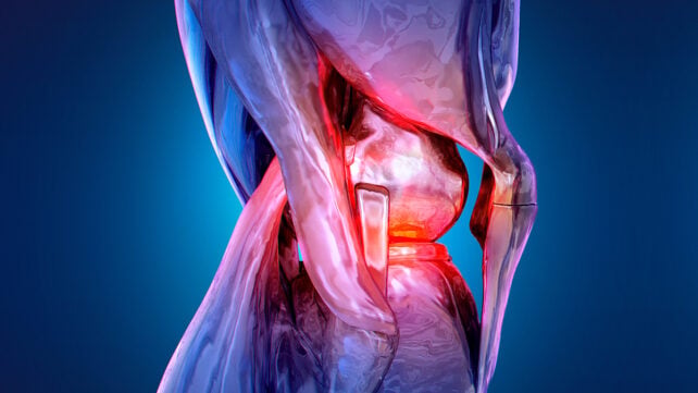 Painful knee