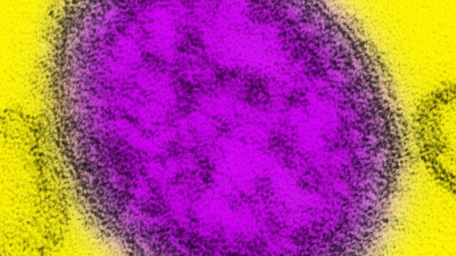 Measles Cases in The US Just Hit a 35-Year High. Here's What's Driving The Surge, And What You Need to Know