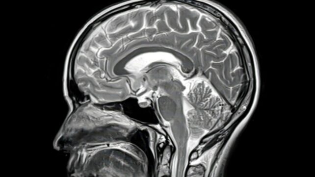 Rare Brain Autopsy Hints at Why Alzheimer's Drugs Are Failing